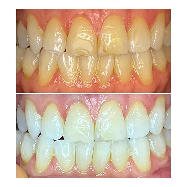 We Whiten Teeth Whitening